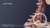 Profile view of the cervical spine labeling scar tissue.