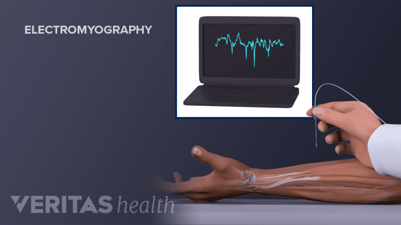Image of electromyography.