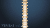 Anterior view of the spine showing a fracture in a thoracic vertebra.