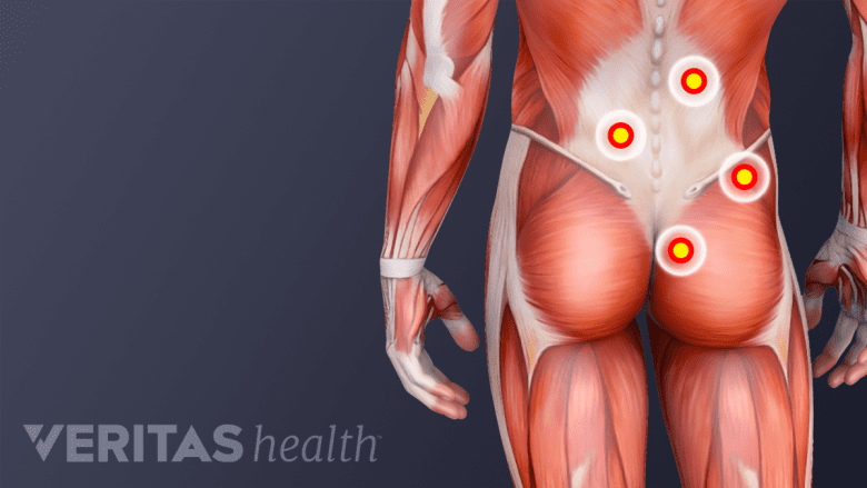 An illustration showing trigger points in the lowerback.