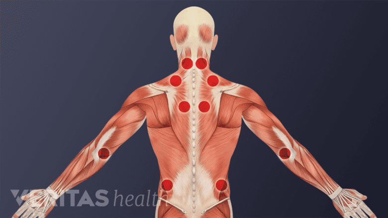 Illustration showing trigger points of myofacial pain syndrome.