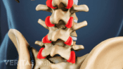 Close up view of a medical illustration of the lumbar spine. The facet joints are highlighted in red.