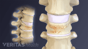 Profile and anterior views of vertebral compression fractures from osteoporosis