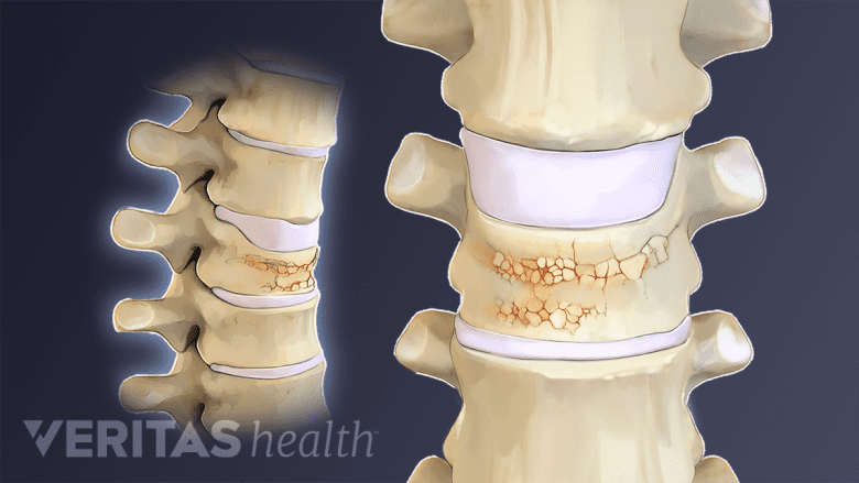 Illustration showing vertebra compression fracture.
