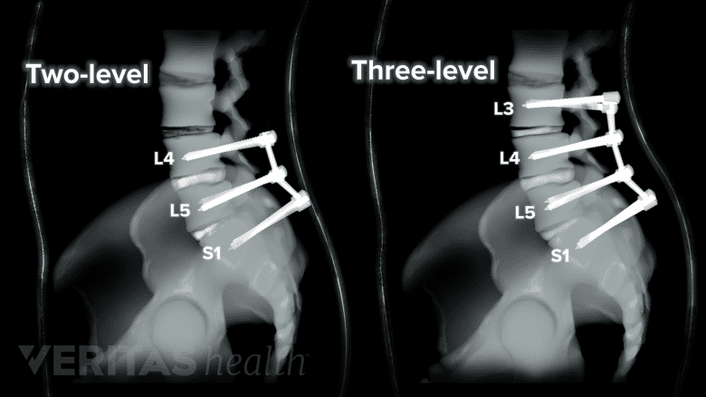 Illustration showing two level and three level spinal fusion.