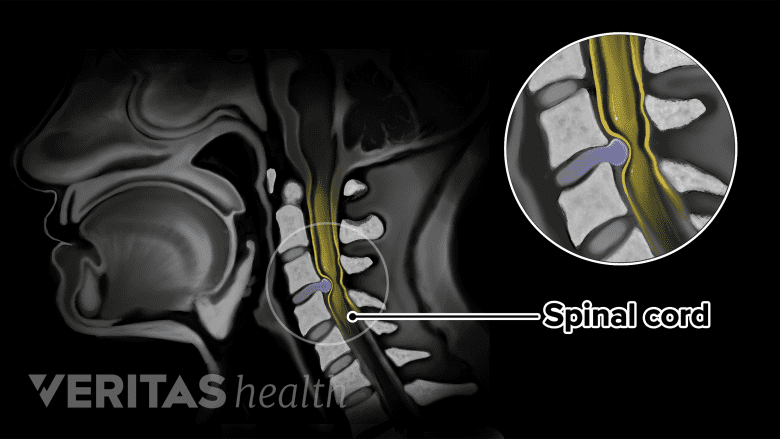 MRI of cervical herniated disc.
