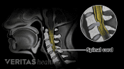 MRI-like illustration of Cervical Myelopathy with Spondylosis