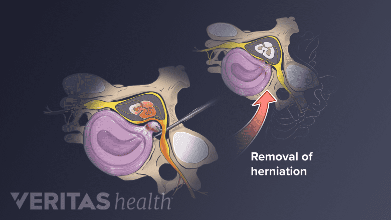 Surgical removal of the herniated part of a spinal disc that's pressing on the spinal nerves.