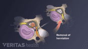 Surgical removal of the herniated part of a spinal disc that's pressing on the spinal nerves.