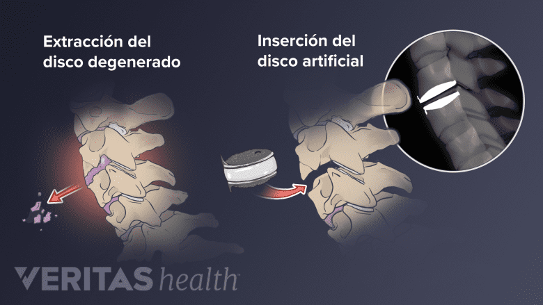 El proceso de la extracción de una hernia discal y la inserción de una artificial.