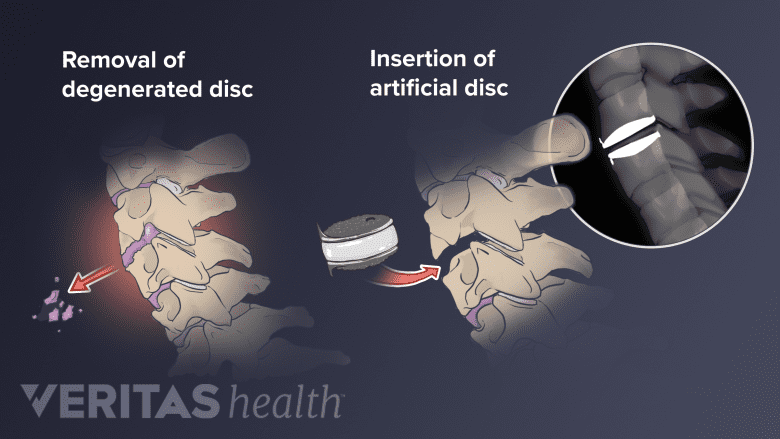 Two-part illustration showing the removal of a herniated disc and the insertion of an artificial one.