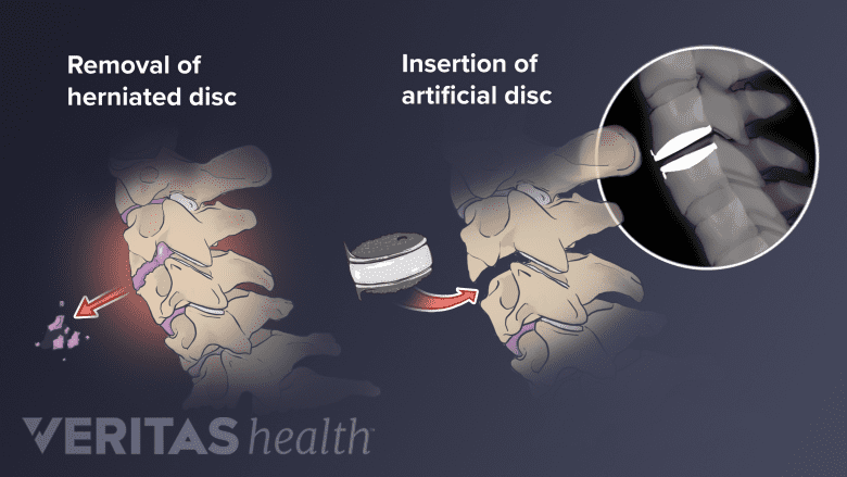 Illustration showing anterior cervical disc replacement.