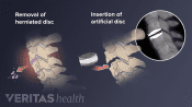 Surgical process of an artificial disc replacement surgery