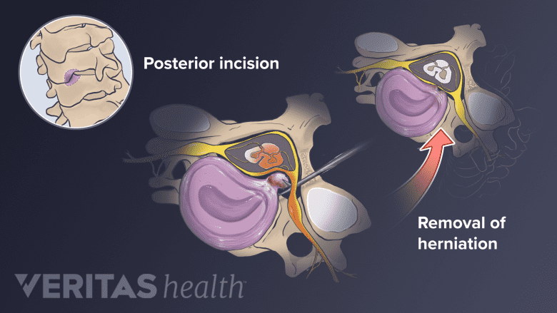Illustration showing cervical vertebra and a inset showing cervical spine with posterior incision.