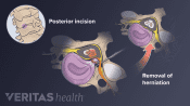 Illustration of the steps of a posterior cervical discectomy