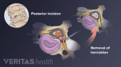 Illustration of the steps of a posterior cervical discectomy