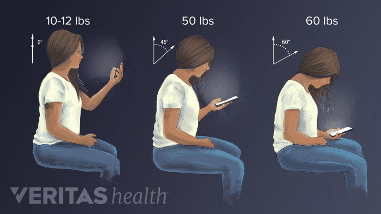 Illustration of text neck.