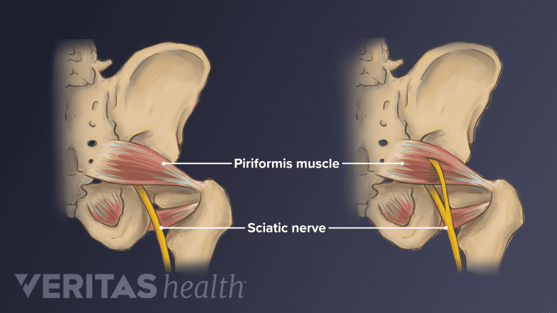 An illustration showing anatomic variation of sciatic nerve.