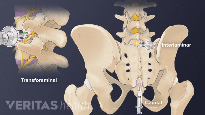 The epidural injection is given using three different techniques.