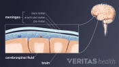 Anatomy of meningitis in the spinal fluid