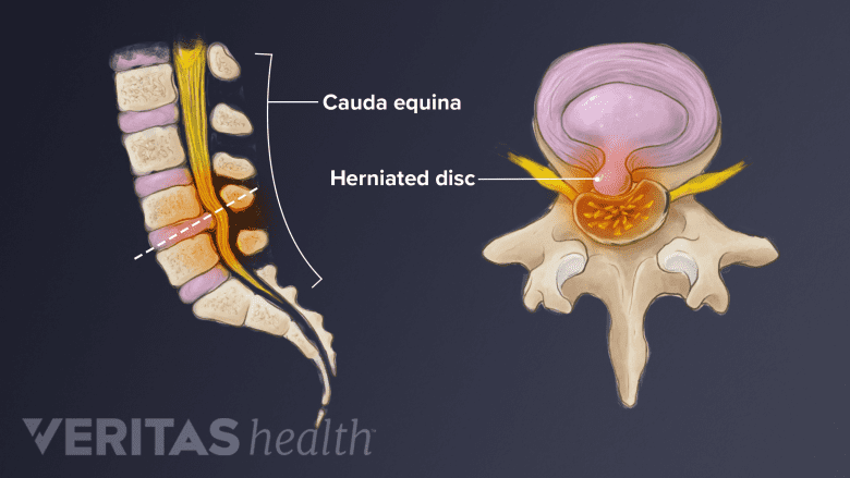 Illustration showing vertebral spine  and a cross section of lumbar vertebra showing herniated disc,