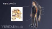Radicular pain highlighted in the cervical spine with man standing upright