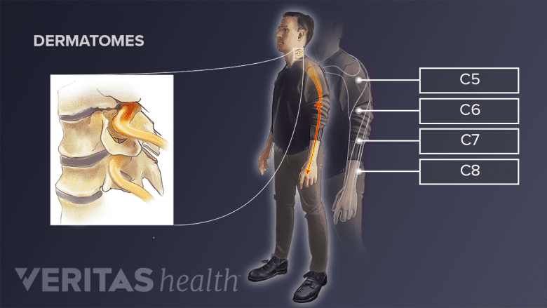 Illustration of areas affected by cervical nerve root causing radiculopathy