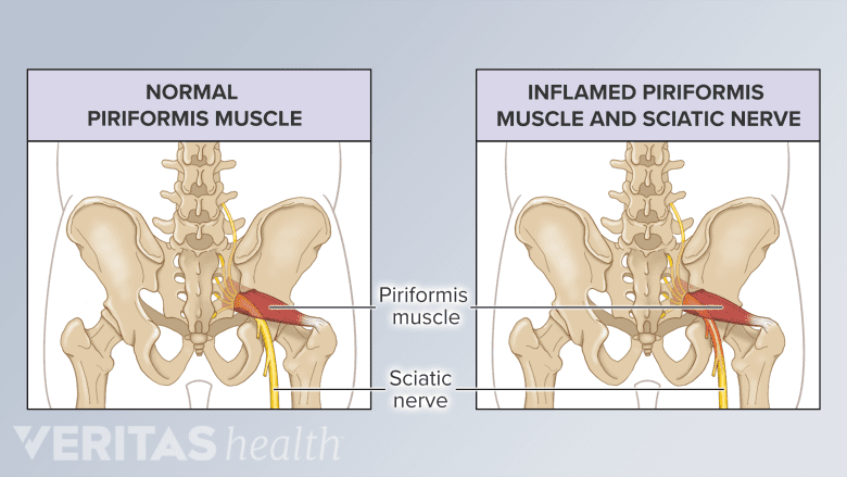 An illustration showing normal vs inflamed piriformis muscle.