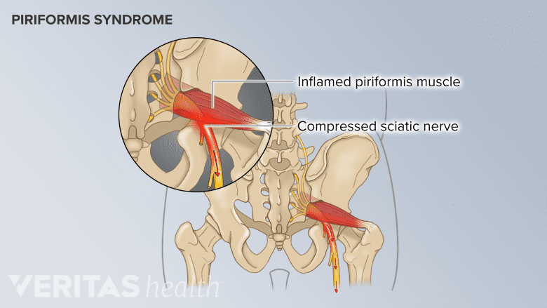 Illustration showing piriformis syndrome, muscle, sciatic nerve, pain, pelvis, pelvic bone