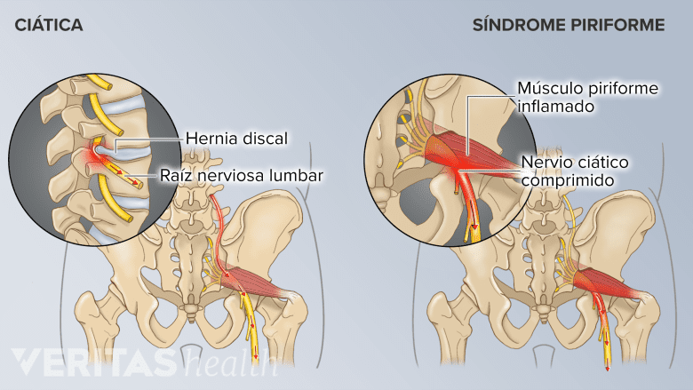 Comparación entre hernias discales y el síndrome piriforme.