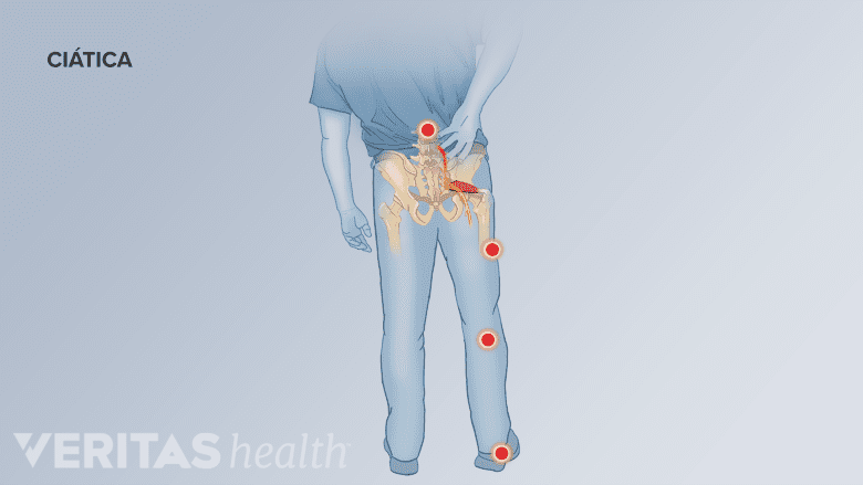 Dolor de ciática recorriendo desde la espalda baja hasta la pierna y los pies.
