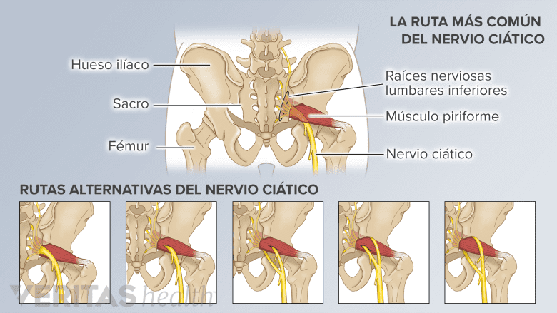 La vía del nervio ciático más común y otras 5 variaciones anatómicas de la vía del nervio.