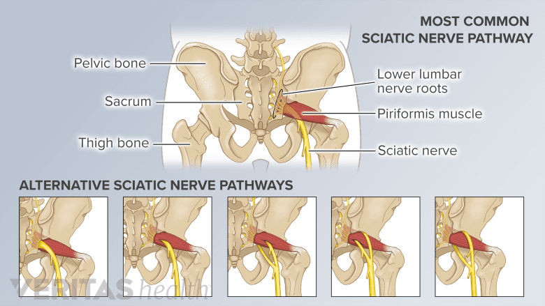 The most common sciatic nerve pathway and 5 other anatomic variations of the nerve's pathway.