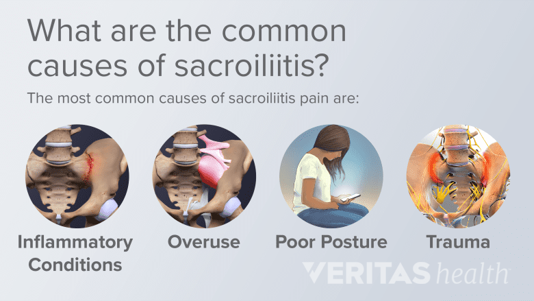 3 side by side images, (left) anatomical close up of human lower back, (center) illustration of a woman holding her back at a computer, (right) Photo of a man sitting on the stairs after falling.