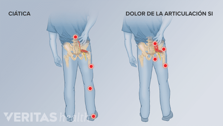 Los diferentes puntos de dolor de la ciática y el dolor en las articulaciones si.