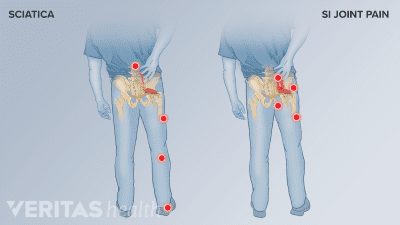Comparison of pain points from Sciatica and SI Joint Pain.