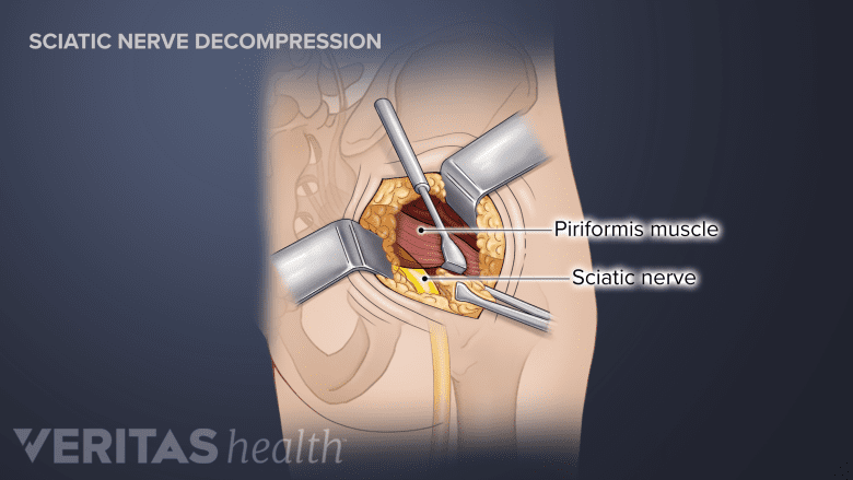 An illustration showing sciatic nerve decompression surgery.