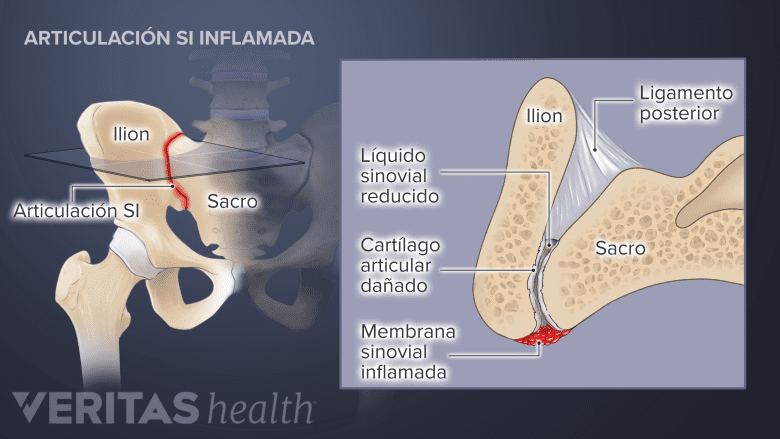 Una articulación SI con inflamación y daño de cartílago.