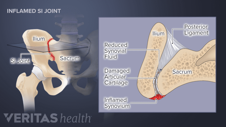 Cross-section of an inflamed SI joint showing damaged articular cartilage, reduced fluid, and inflamed synovial membrane.
