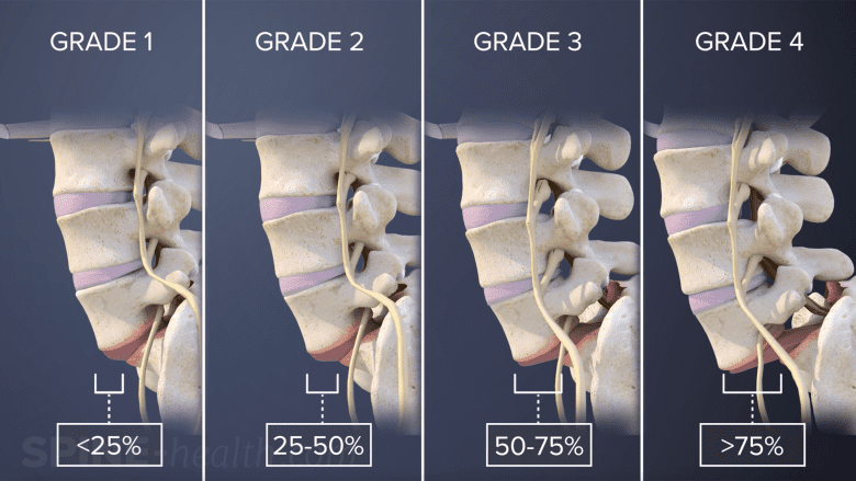 Illustration showing grades of isthemic spondylolisthesis.
