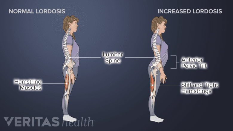 Illustration of normal and increased lordotic curves in the lower back highlighting anterior pelvic tilt and tight hamstrings.