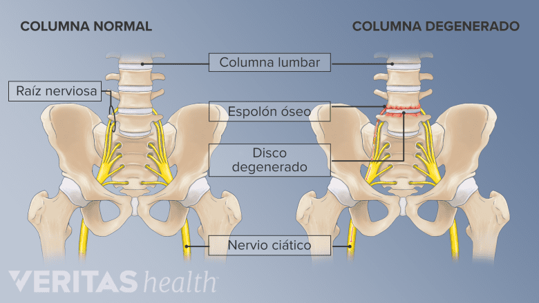 Una columna lumbar normal y una degenerada con problemas óseos y discales.