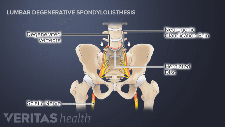 Illustration degenerative spondylolisthesis in the L4-L5 spinal segment causing neurogenic claudication pain.