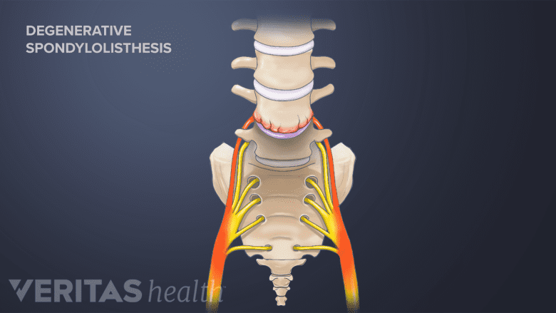 Illustration showing degenerative spondylolisthesis.
