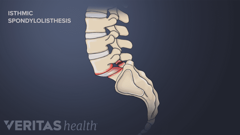 Illustration showing isthemic spondylolesthesis