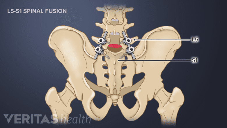 Illustration showing pelvis with fused L1-S5 segment.