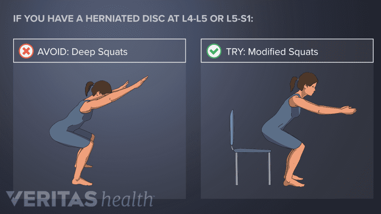 Avoid deep squats with L4-L5 or L5-S1 disc herniation. Try Modified squats.
