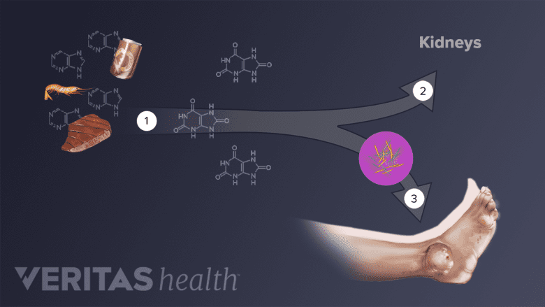 Purines found in foods are metabolized by the body and turned into uric acid (1). Uric acid is normally filtered out of the bloodstream by the kidneys (2). Excess uric acid in the bloodstream can lead to the formation of uric acid crystals in one or more