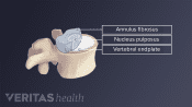 Illustration of anatomy of lumbar vertebra labelling nucleus pulpous, annulus fibrosis, and vertebral end plate.