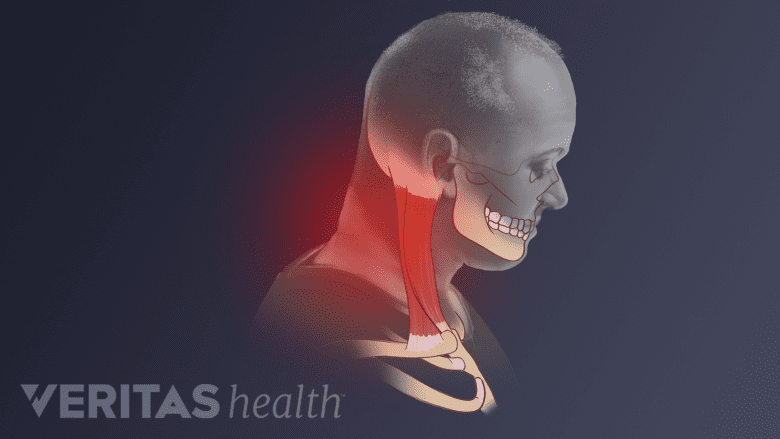 Medical illustration showing forward headtilt with red highlight in the neck region.